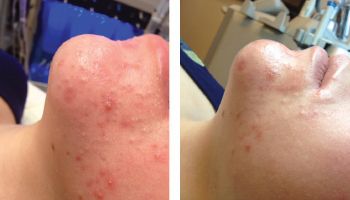 Acne Treatment, spots