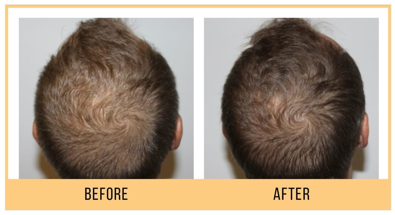 Keravive Hair & Scalp treatment | Arden Clinic