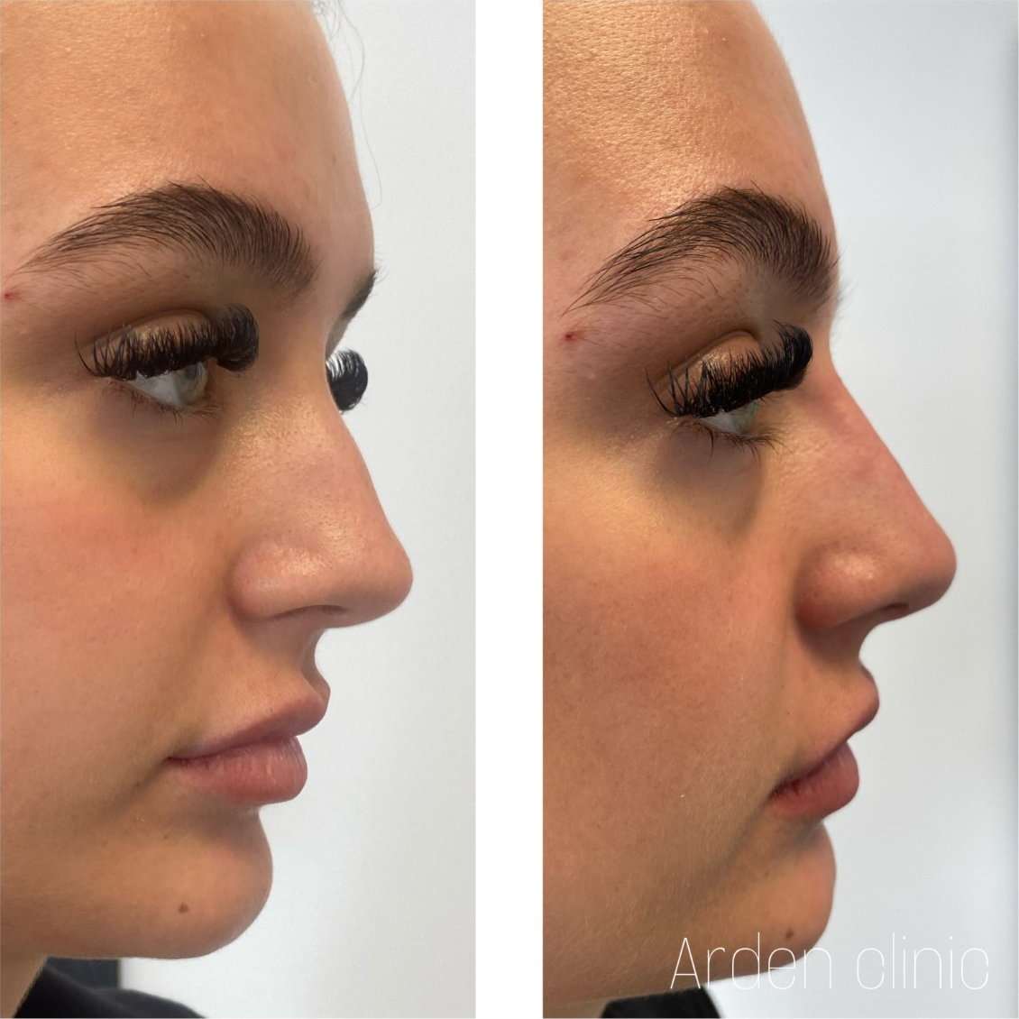 Non surgical ‘nose job' BEFORE/AFTER