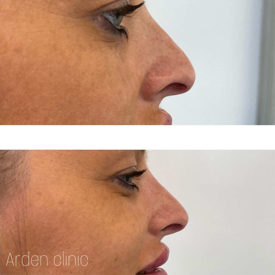 Non surgical ‘nose job' BEFORE/AFTER