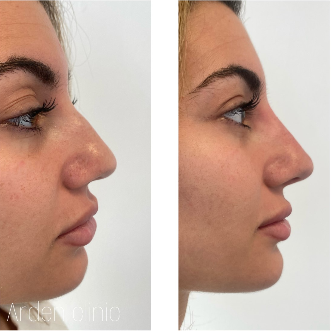 Non surgical ‘nose job' BEFORE/AFTER