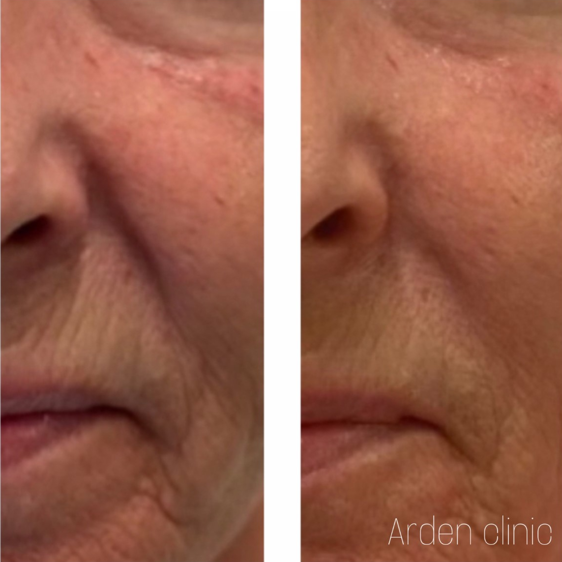 Dermal Fillers for Nasolabial Fold BEFORE/AFTER