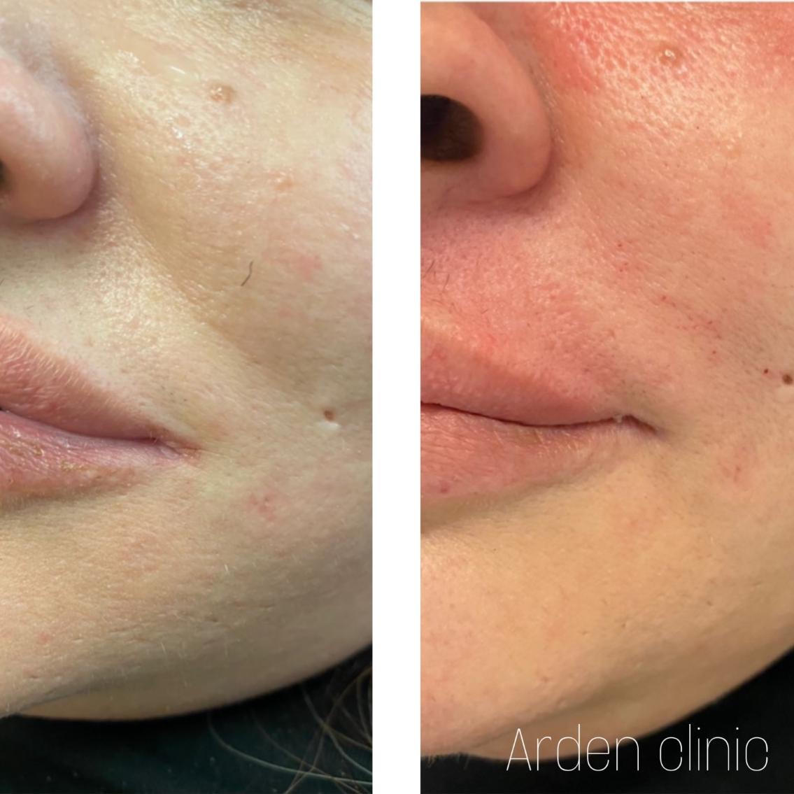 Dermal Fillers for Nasolabial Fold BEFORE/AFTER