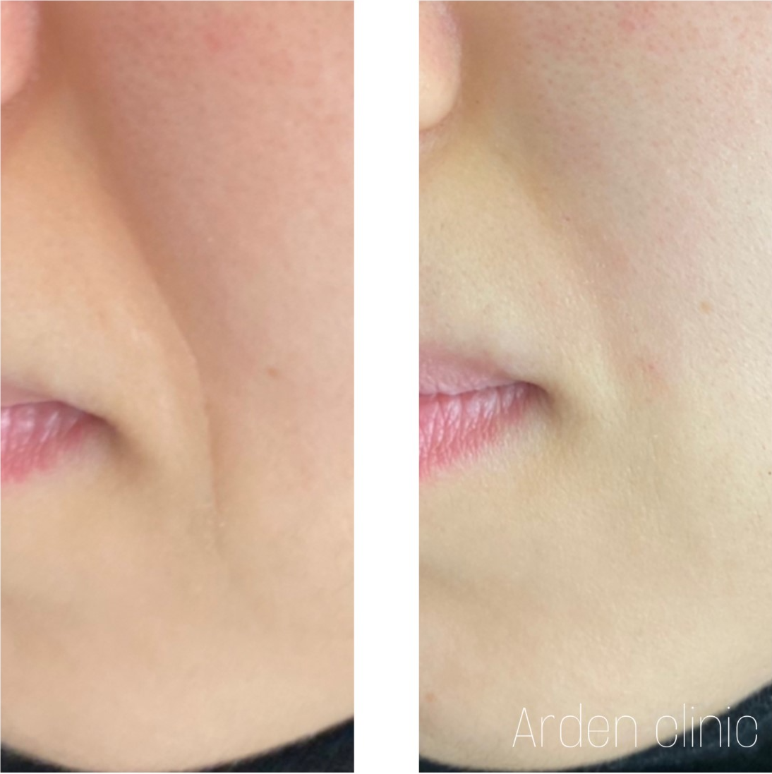 Dermal Fillers for Nasolabial Fold BEFORE/AFTER