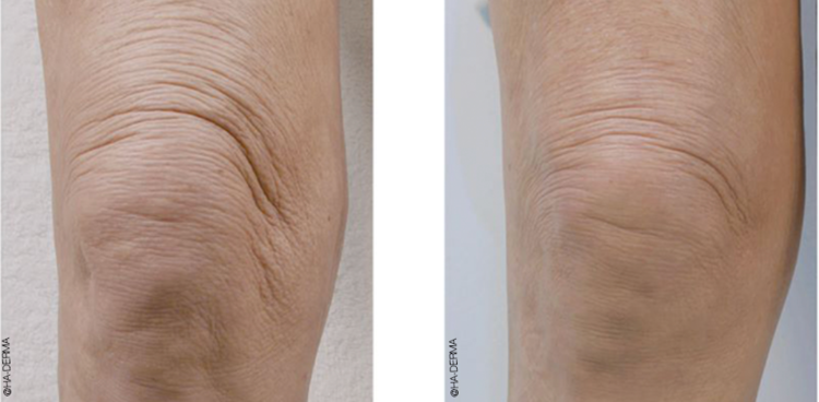 profhilo knees before after