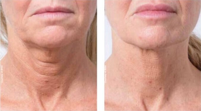 profhilo neck before after