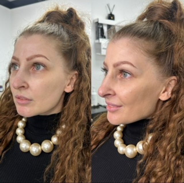Profile balancing dermal fillers