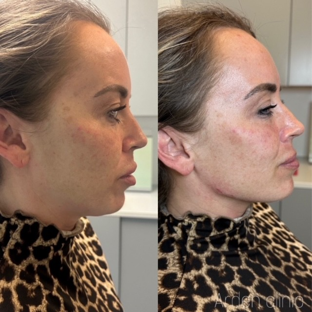 Profile balancing dermal fillers