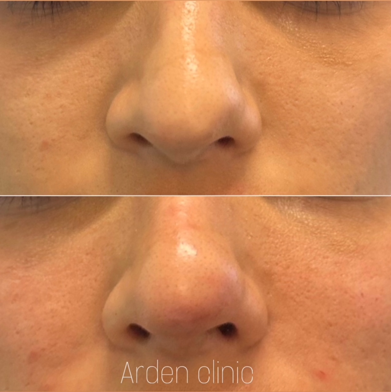 non surgical rhinoplasty nose filler
