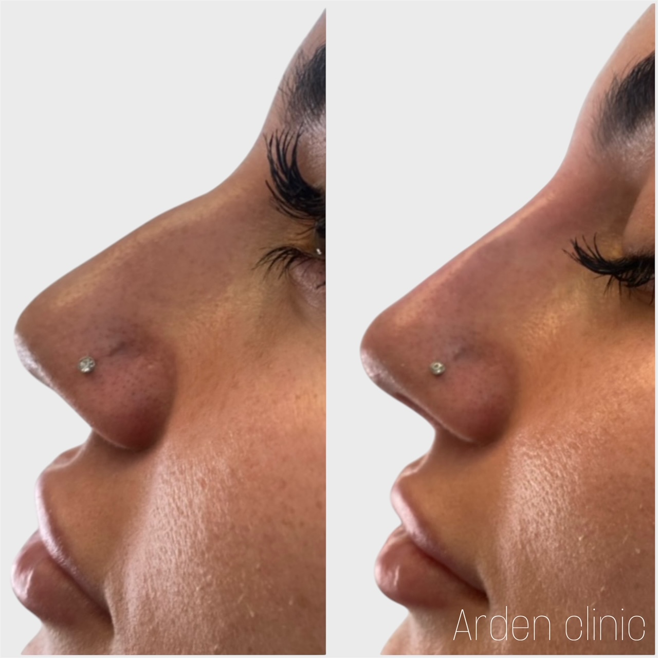 Nose filler Bradford Leeds