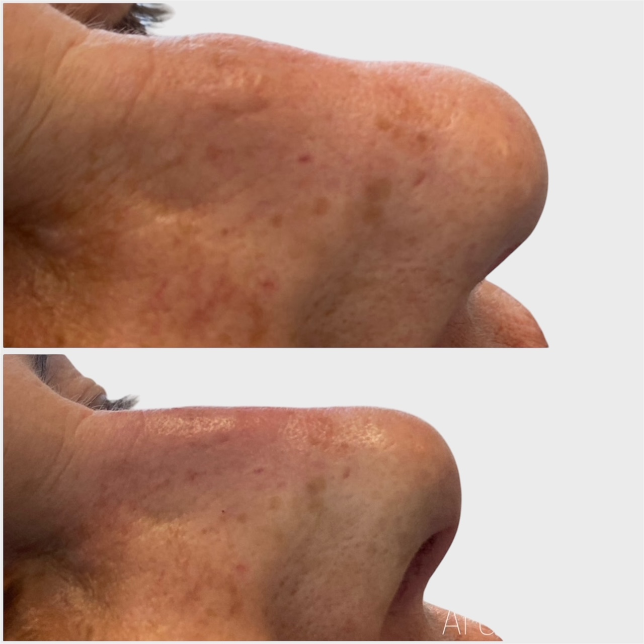 Nose filler Bradford Leeds
