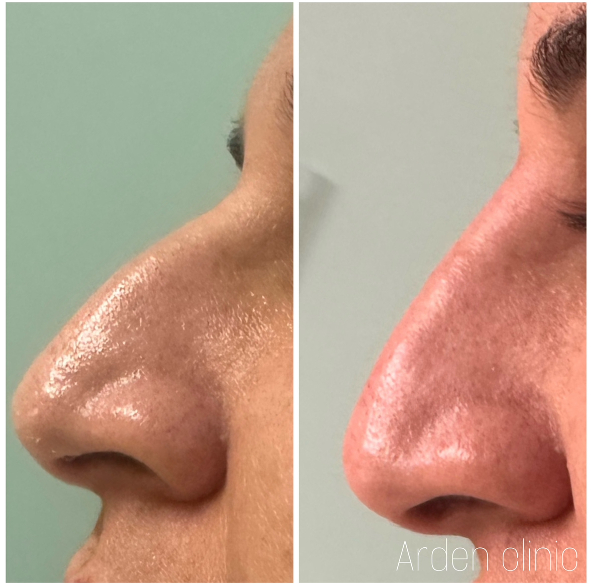 dermal fillers nose bradford