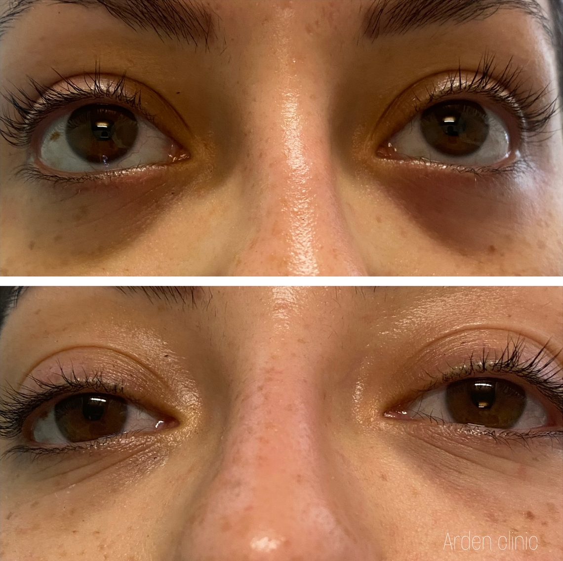 before and after dark circles filler bradford