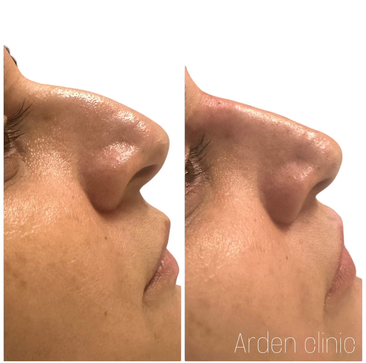 nose filler Arden clinic Bradford