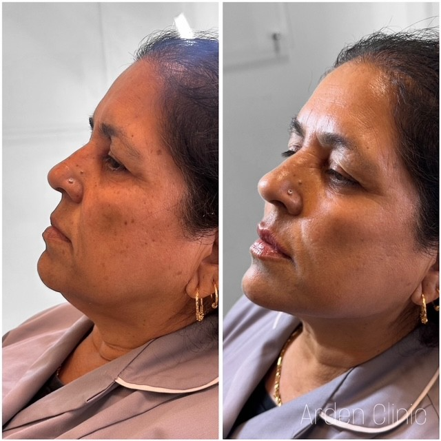 Face lifting achieved with dermal fillers with Arden clinic Bradford and Leeds