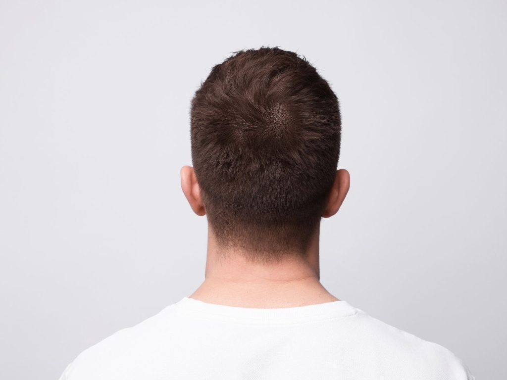 Hair loss injections Bradford