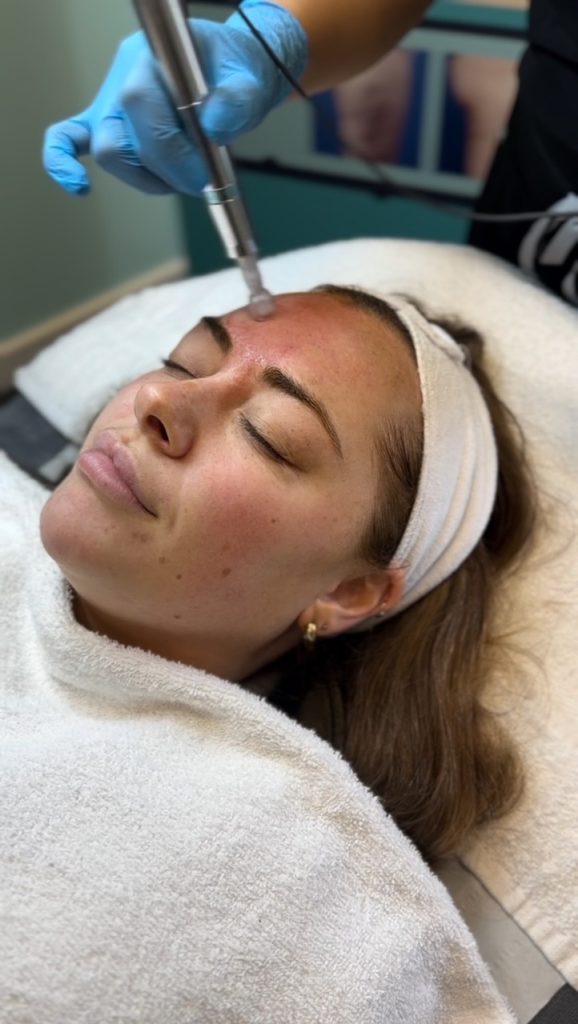 Microneedling Bradford