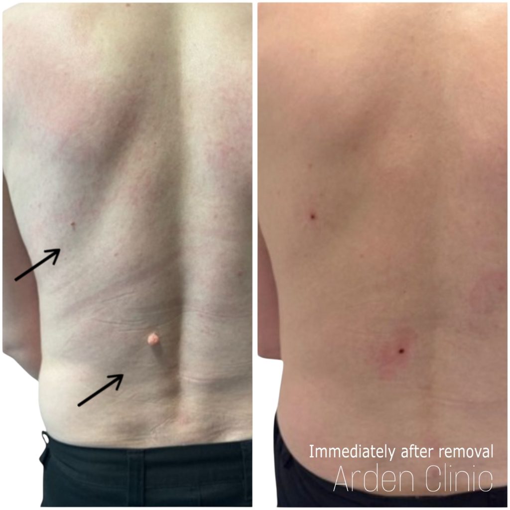 skin tag removal before after in bradford