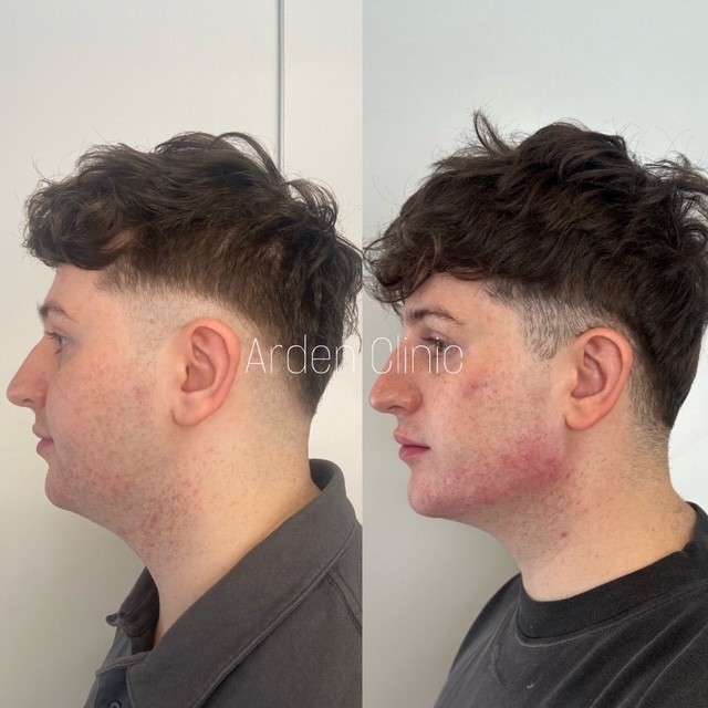dermal fillers before after bradford