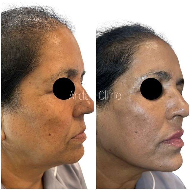 dermal fillers bradford before after