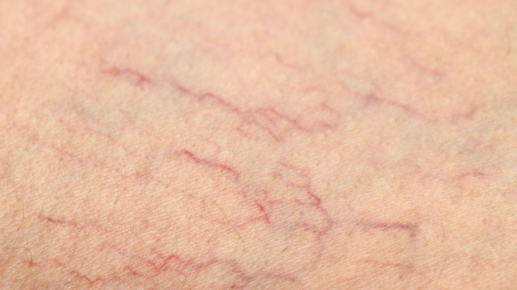 Advanced laser treatment for spider veins, facial redness and broken capillaries in Bradford