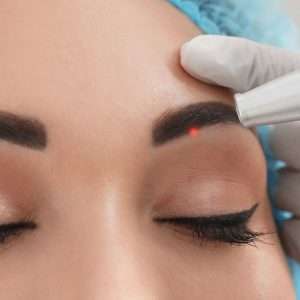 Eyebrow tattoo removal with Pico laser Bradford