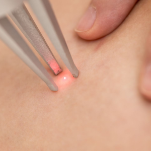 Laser thread vein removal treatment at Arden Clinic Bradford for facial broken capillaries and visible red veins