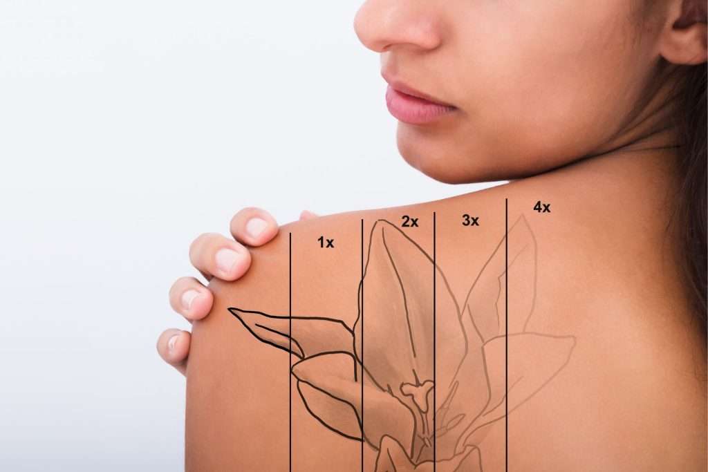Pico Laser tattoo removal Leeds