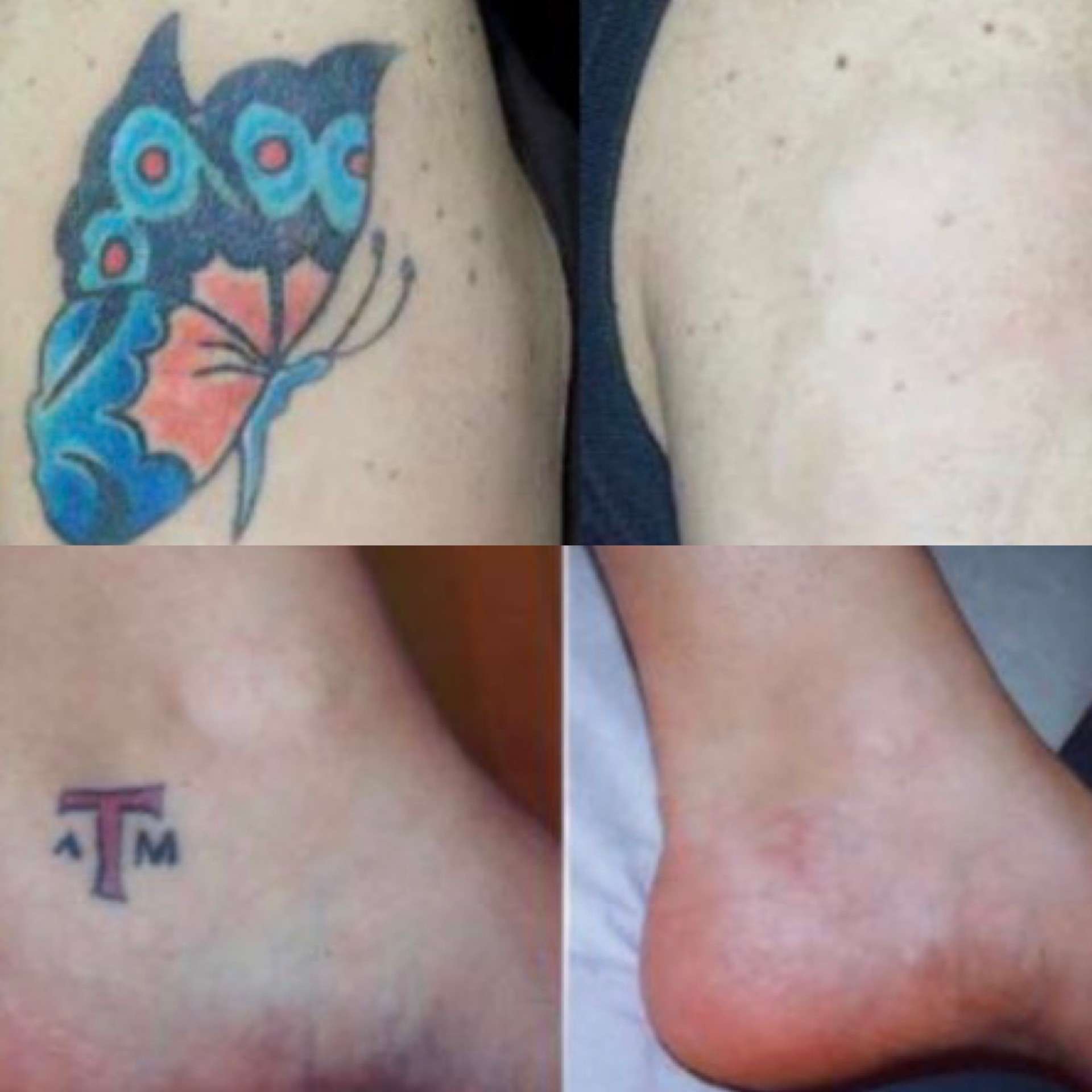Pico laser tattoo removal before after 1