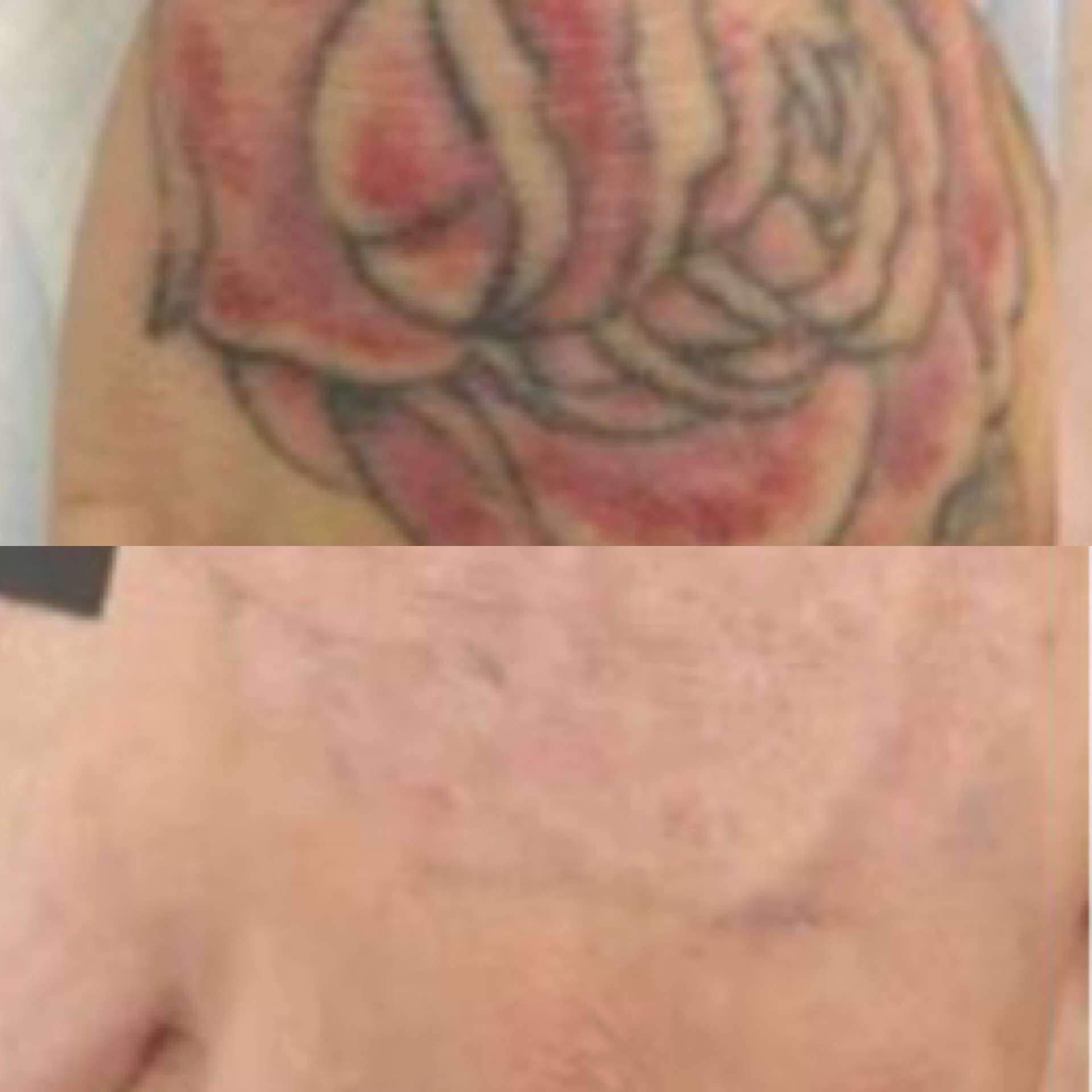 Pico laser tattoo removal before after 2
