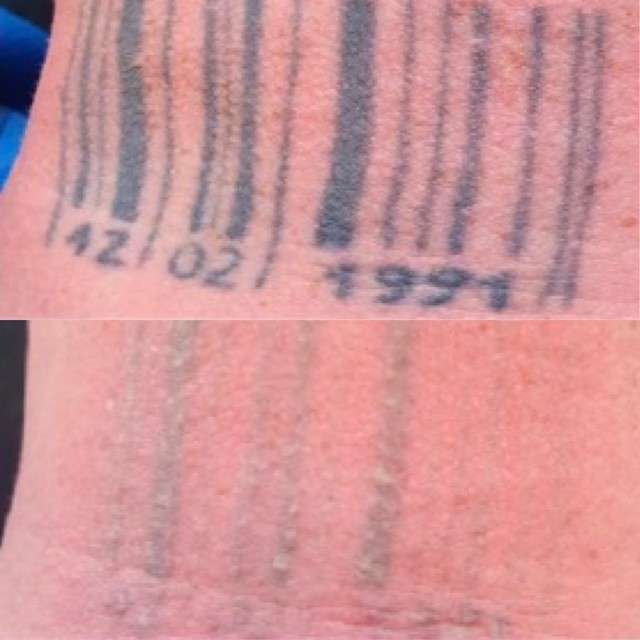 Pico laser tattoo removal before after 3