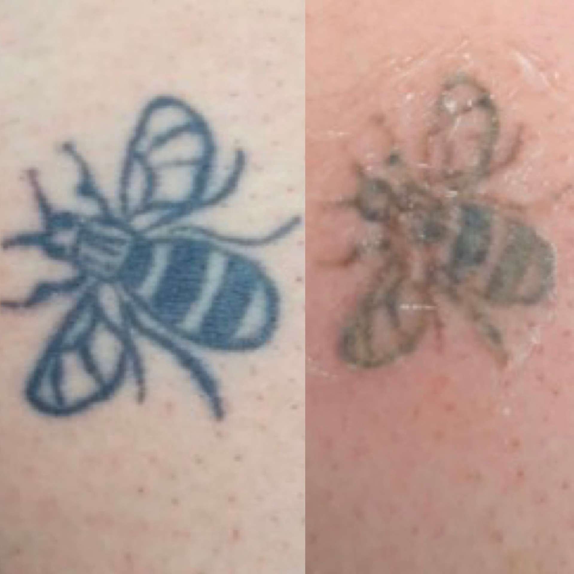 Pico laser tattoo removal before after 4
