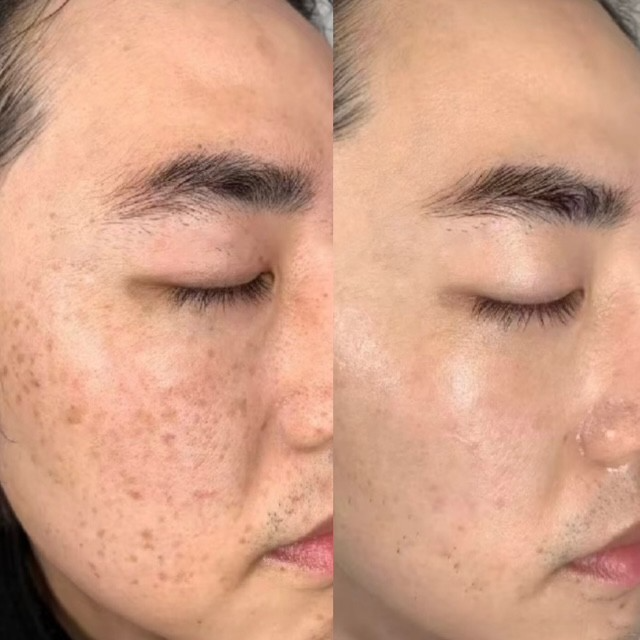 Pico pigmentation treatment before after 1