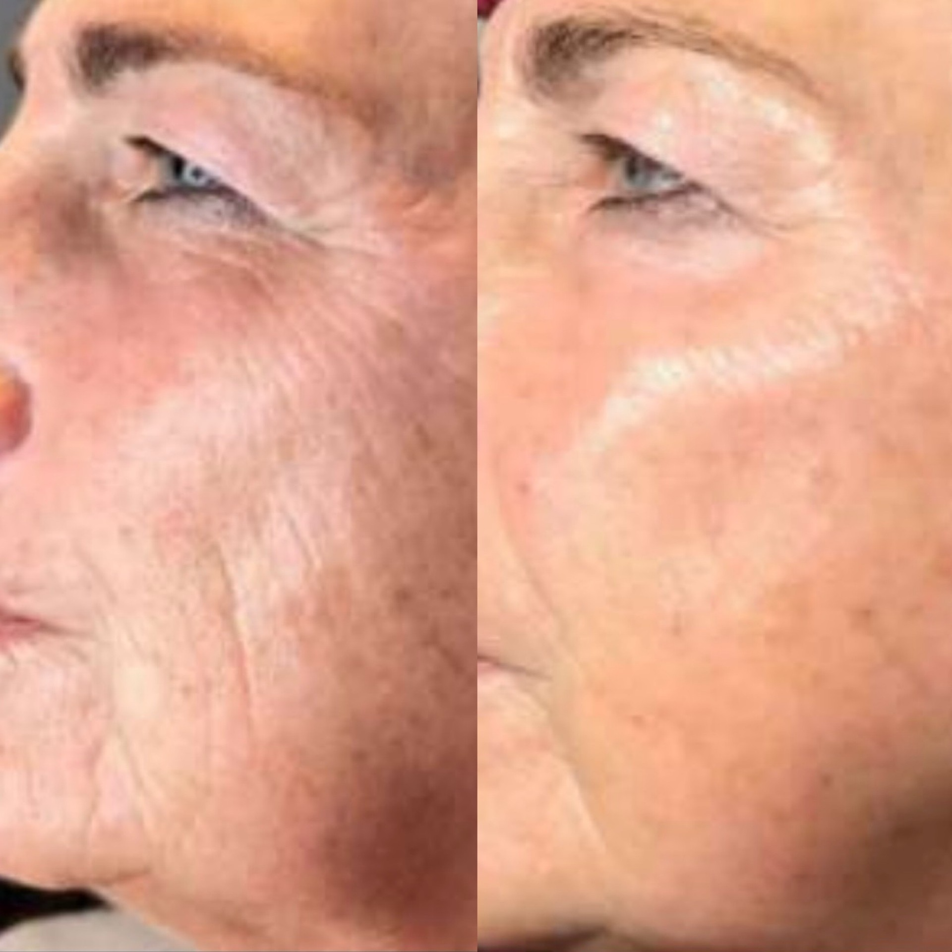 Pico pigmentation treatment before after 2
