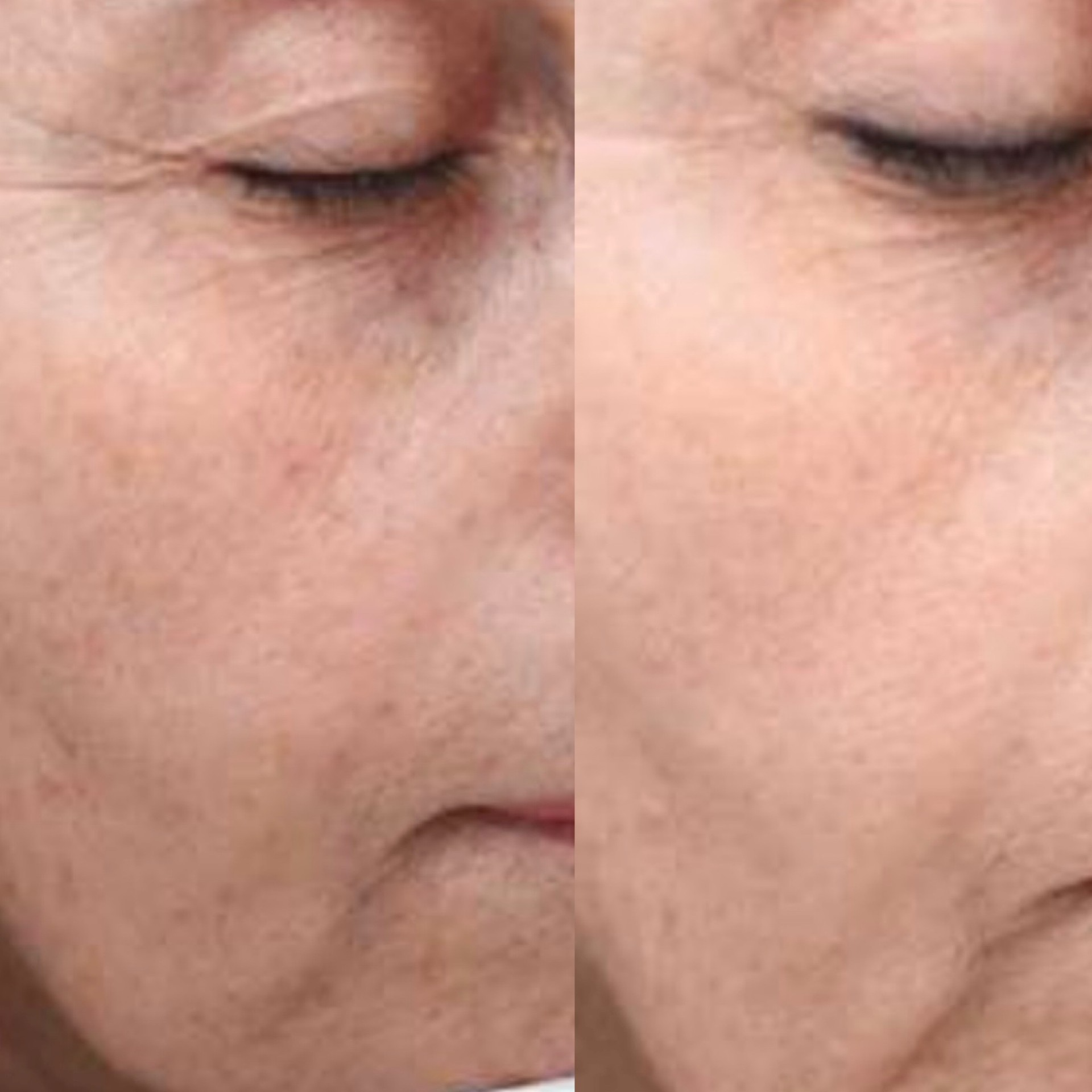 Pico pigmentation treatment before after 3