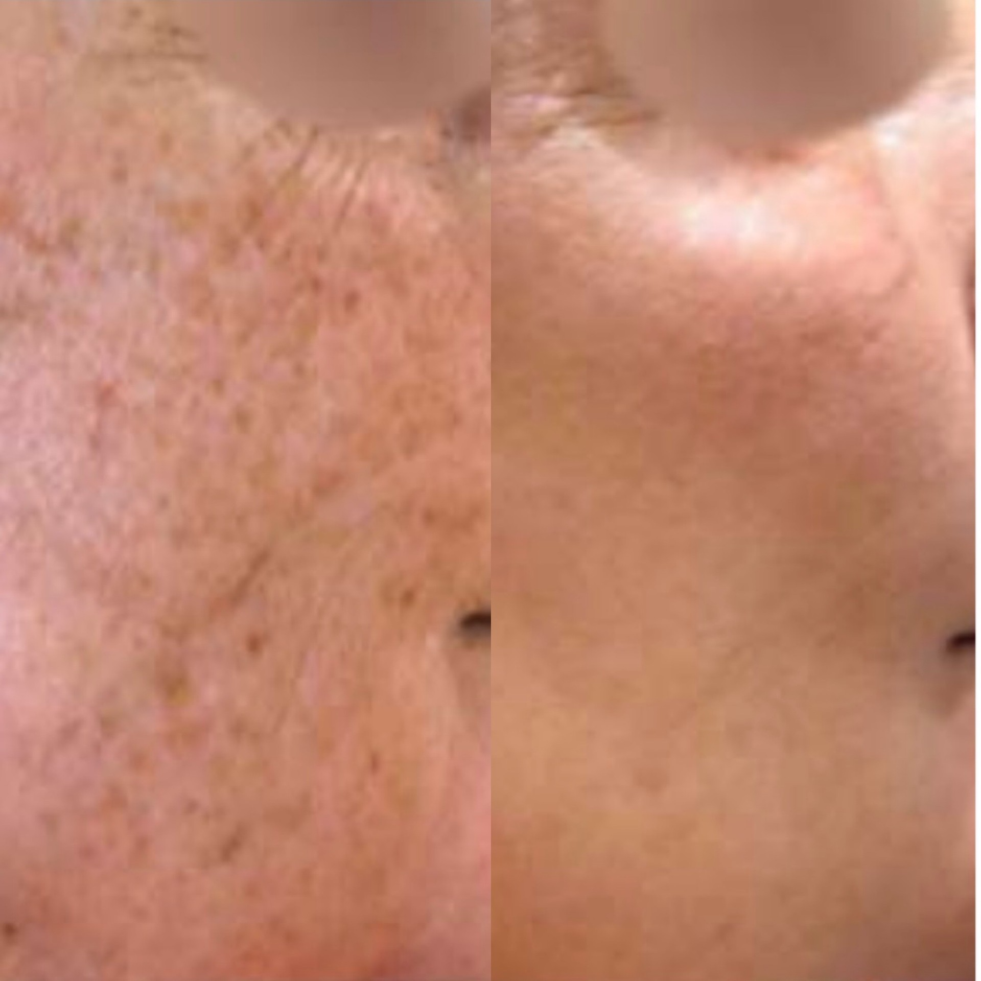 Pico pigmentation treatment before after 4