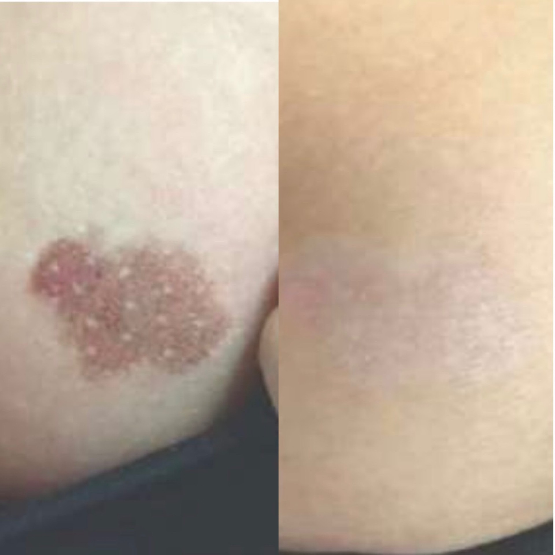 Pico pigmentation treatment before after 5