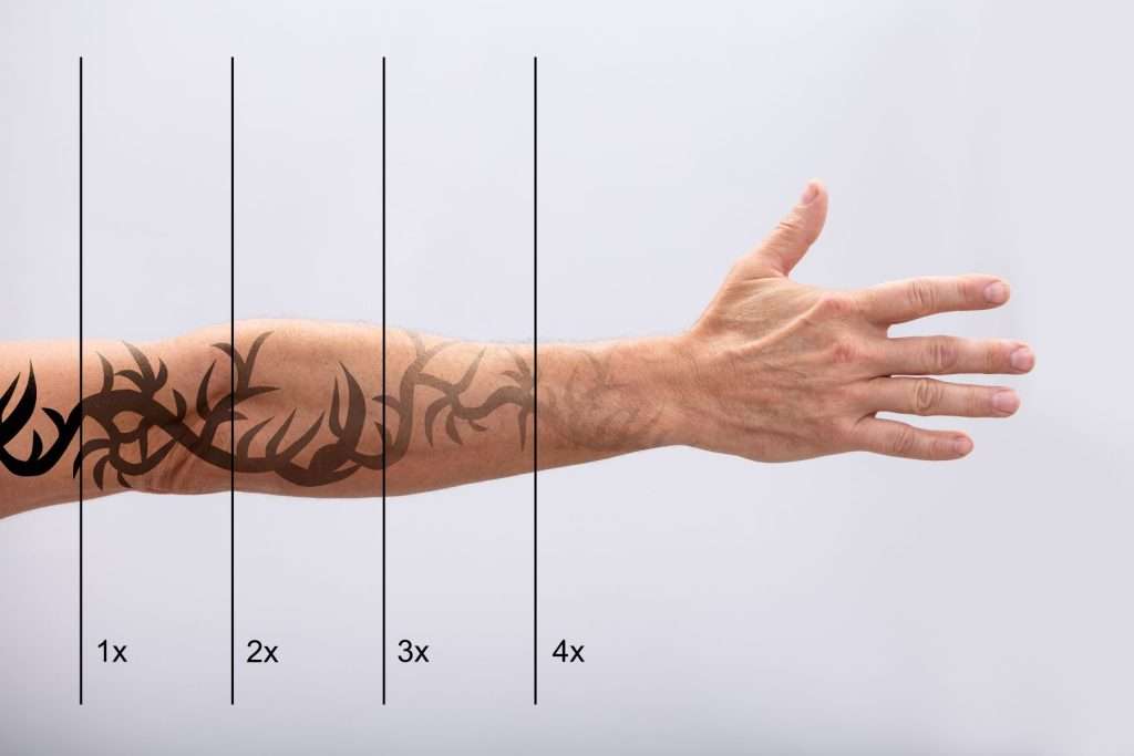 Tattoo removal West Yorkshire