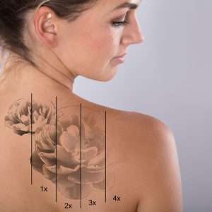 laser tattoo removal in Bradford
