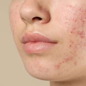Advanced Picosecond laser acne treatment at Arden Clinic Bradford