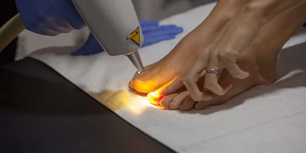 Advanced laser treatment for fungal nail infections