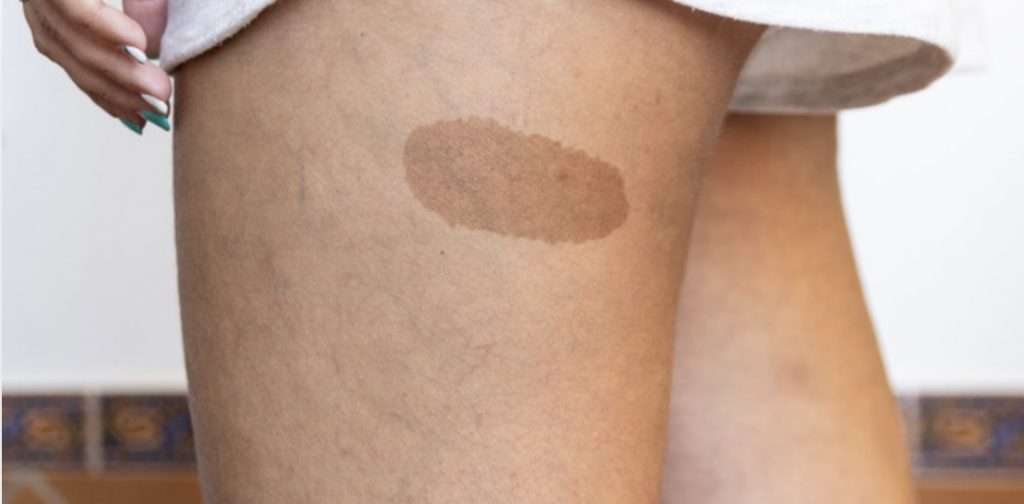 Advanced laser treatment for pigmented birthmarks in Bradford