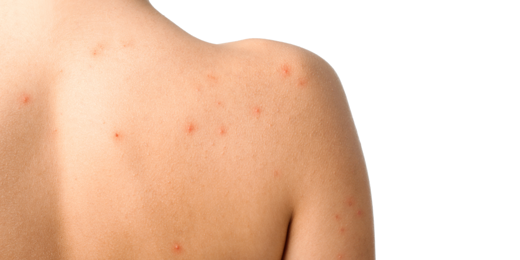 Laser Acne Treatment in Bradford