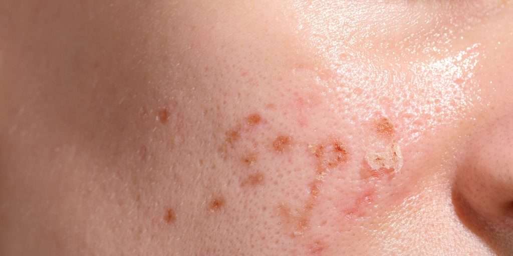 Laser treatment for facial and body acne using Picosecond technology
