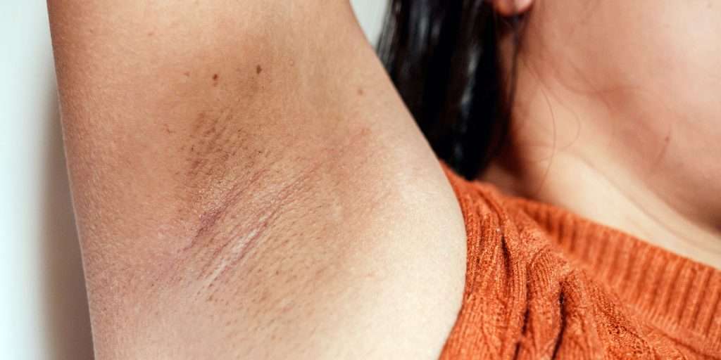 Laser treatment for intimate pigmentation in Bradford