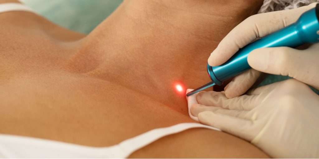 Picosecond laser birthmark treatment at Arden Clinic Bradford