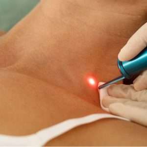 Picosecond laser birthmark treatment at Arden Clinic Bradford