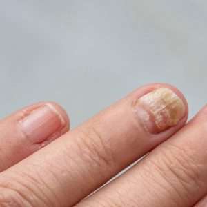 Picosecond laser treatment for fungal toenails at Arden Clinic Bradford