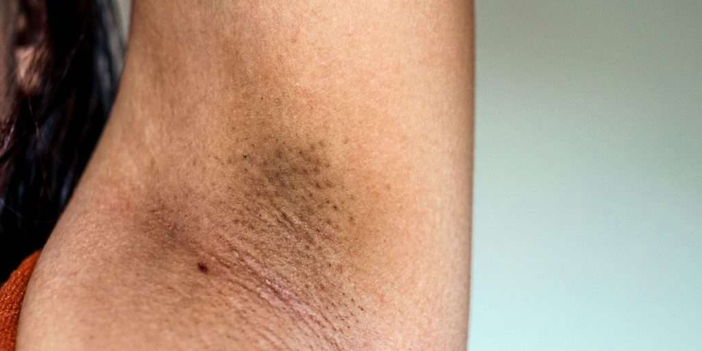 Underarm pigmentation treatment using advanced Picosecond laser technology