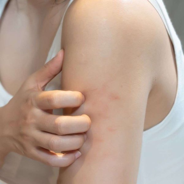 Acne Arms